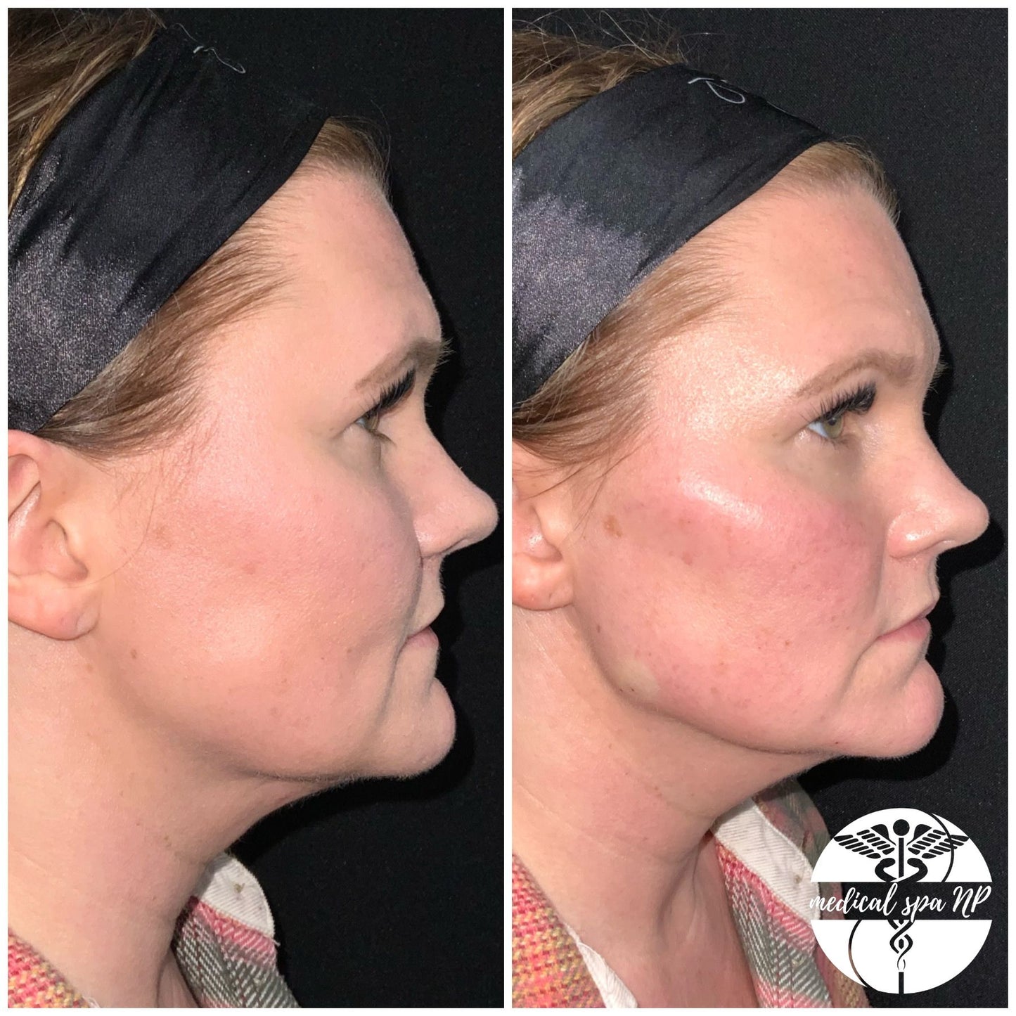 BOGO Filler- Juvederm Voluma