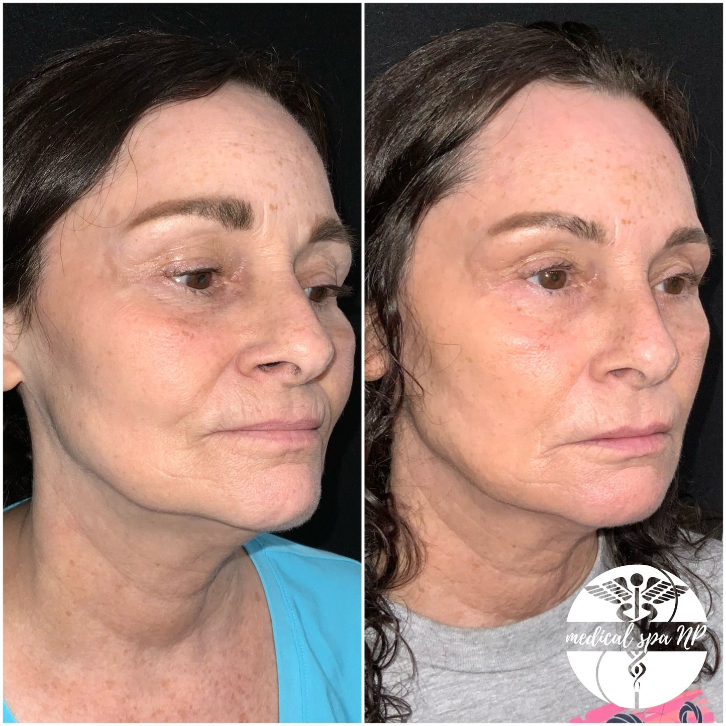 BOGO Filler- Juvederm Voluma