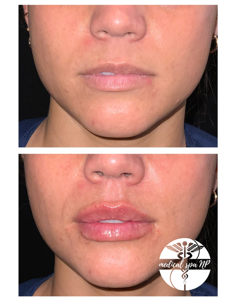 LIPS! Plump and Glow Lip Filler