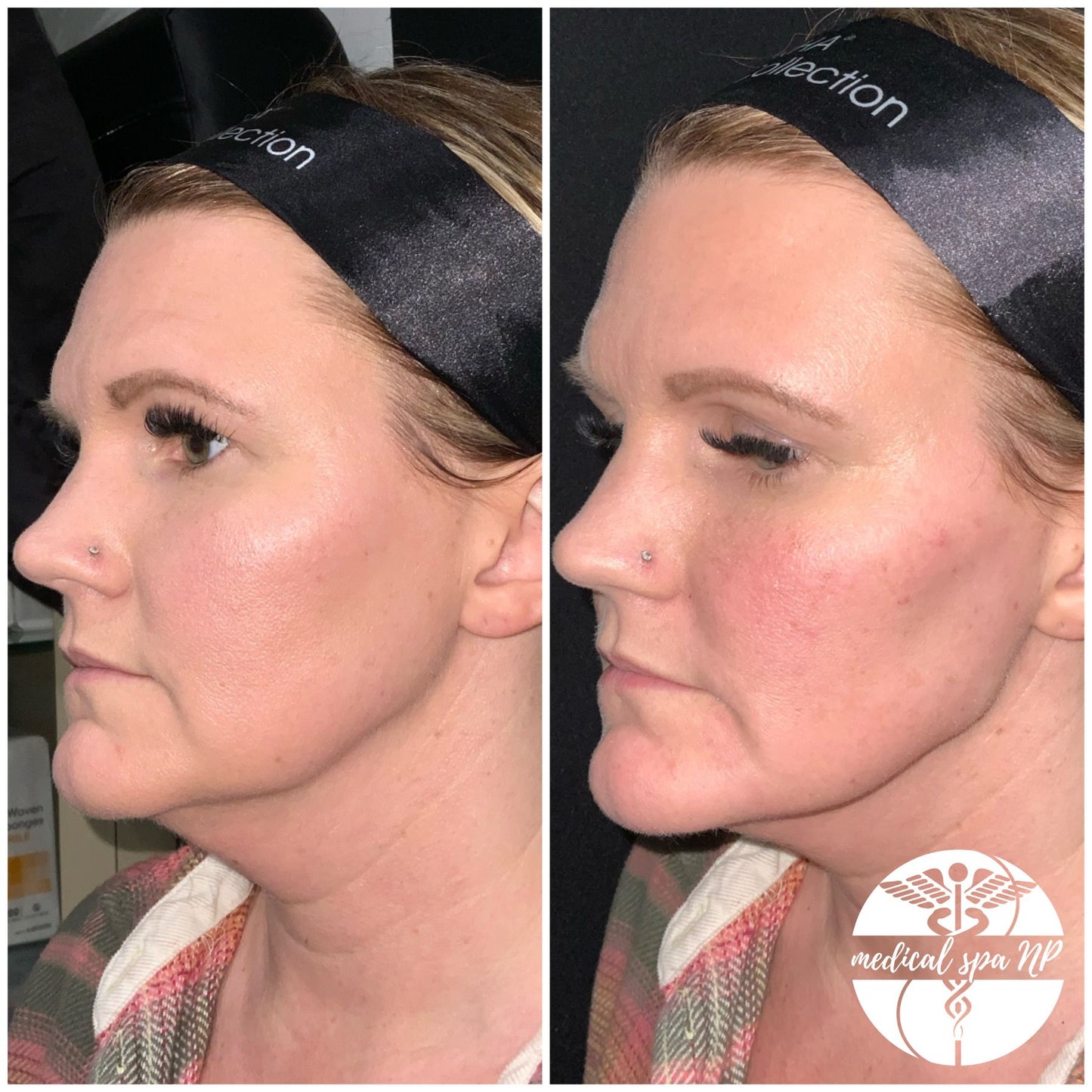 BOGO Filler- Juvederm Voluma