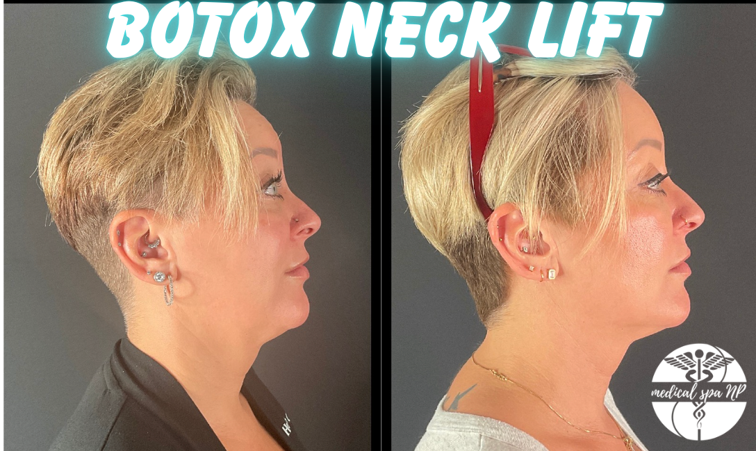 FREE AREA BOTOX! Smooth and Glow