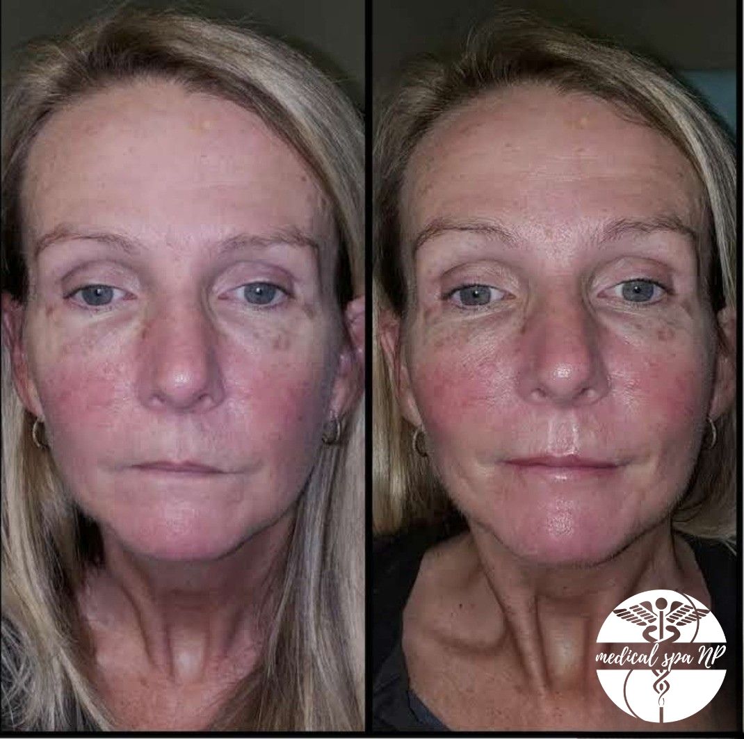 Juvederm Volbella Flash Sale