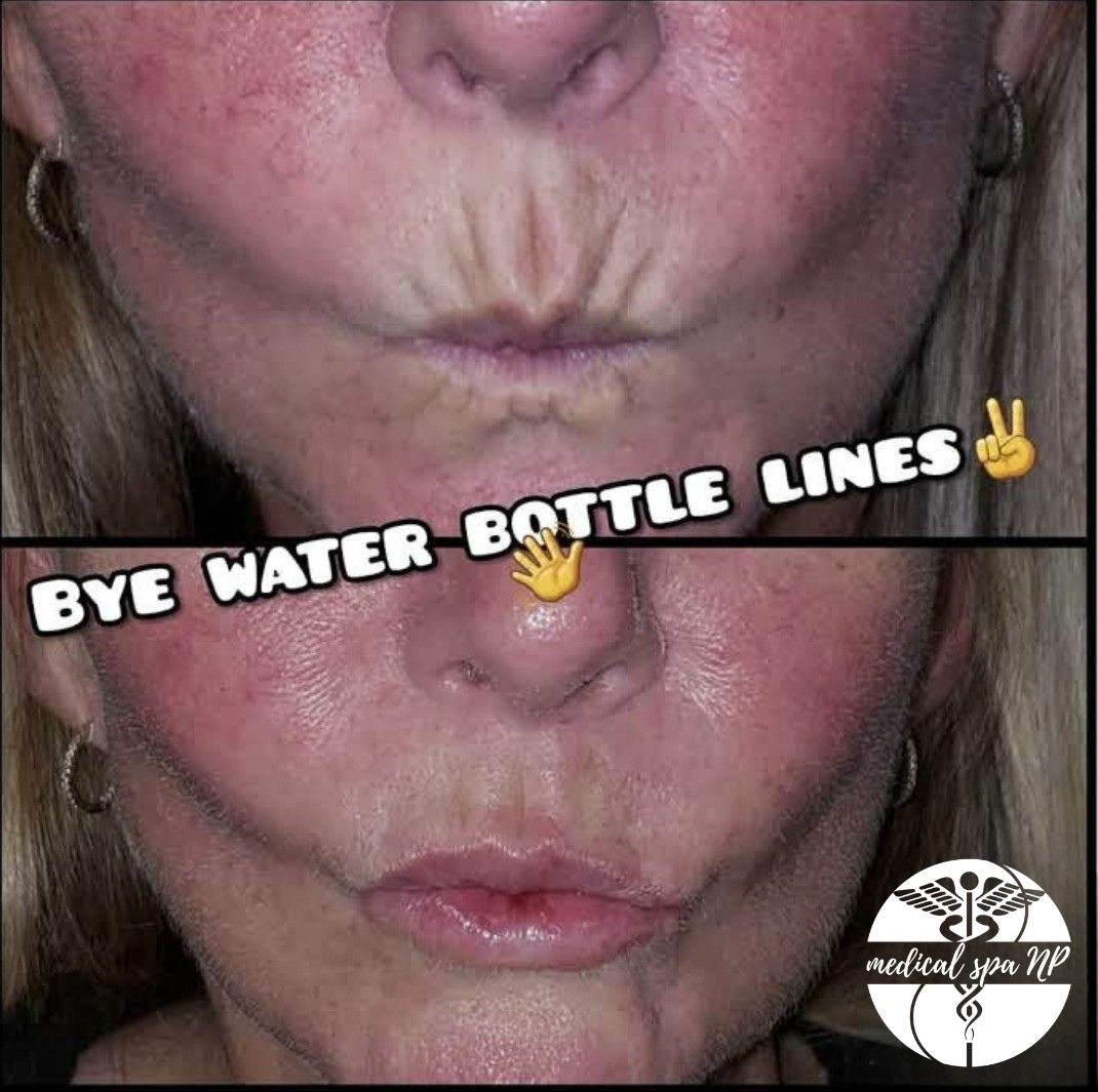 Juvederm Volbella Flash Sale