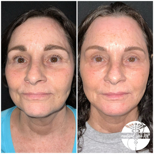 BOGO Filler- Juvederm Voluma