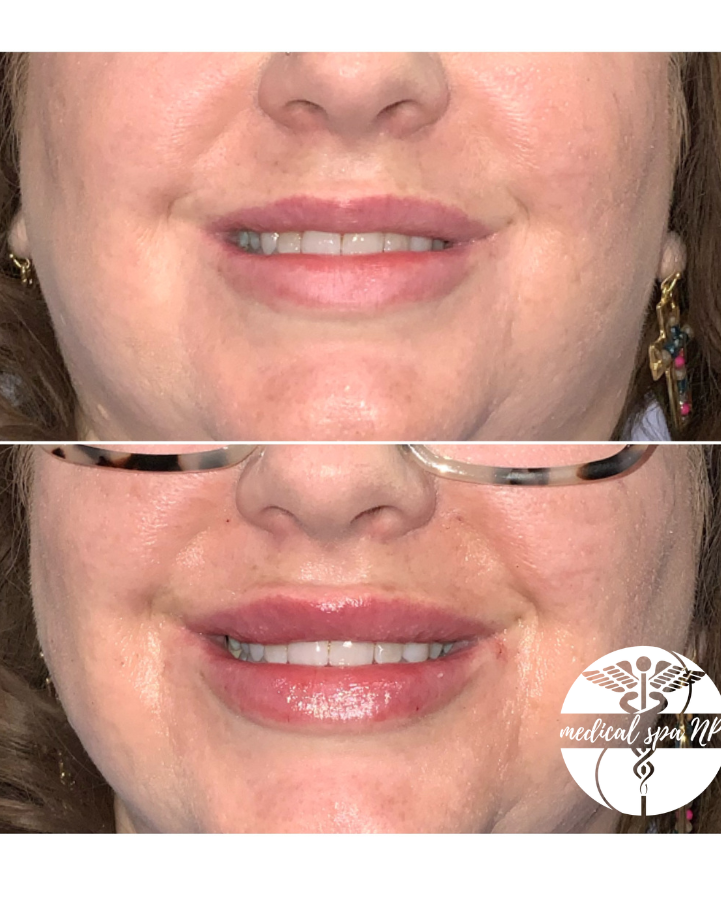 LIPS! Plump and Glow Lip Filler