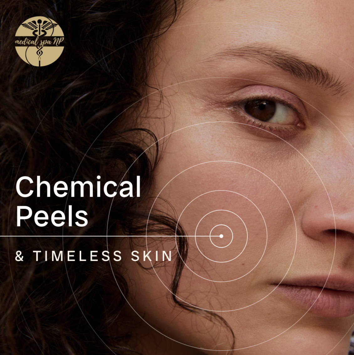 PEELS! Chemical Peel