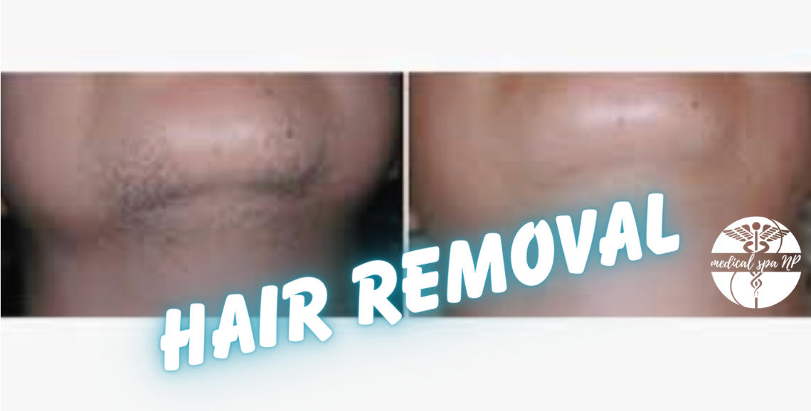 BYE HAIR! Laser Hair Removal