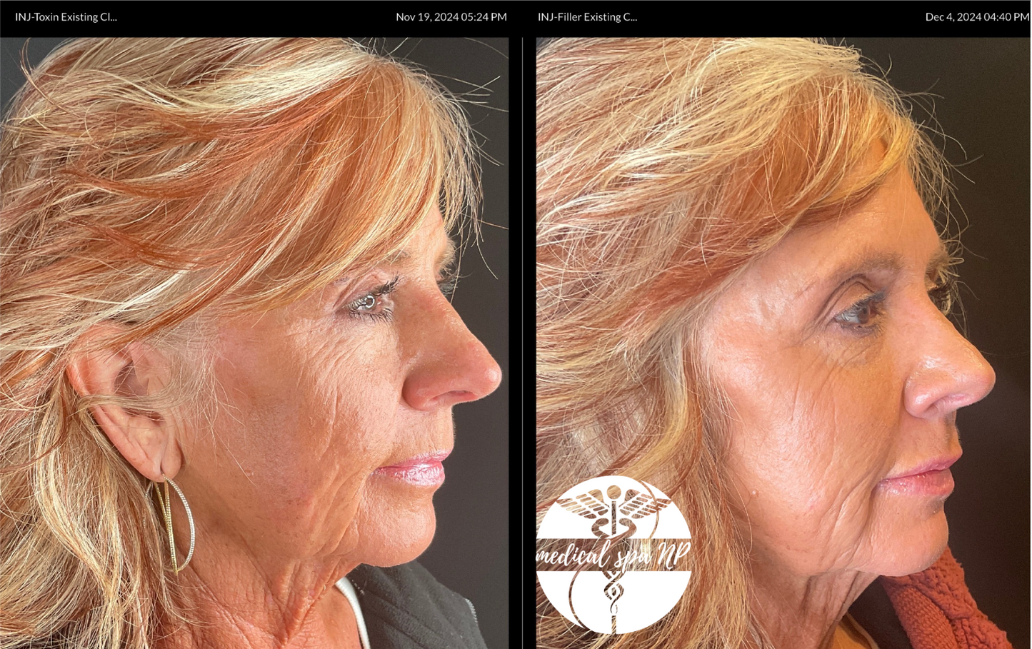 REVERSE AGING! Microneedling