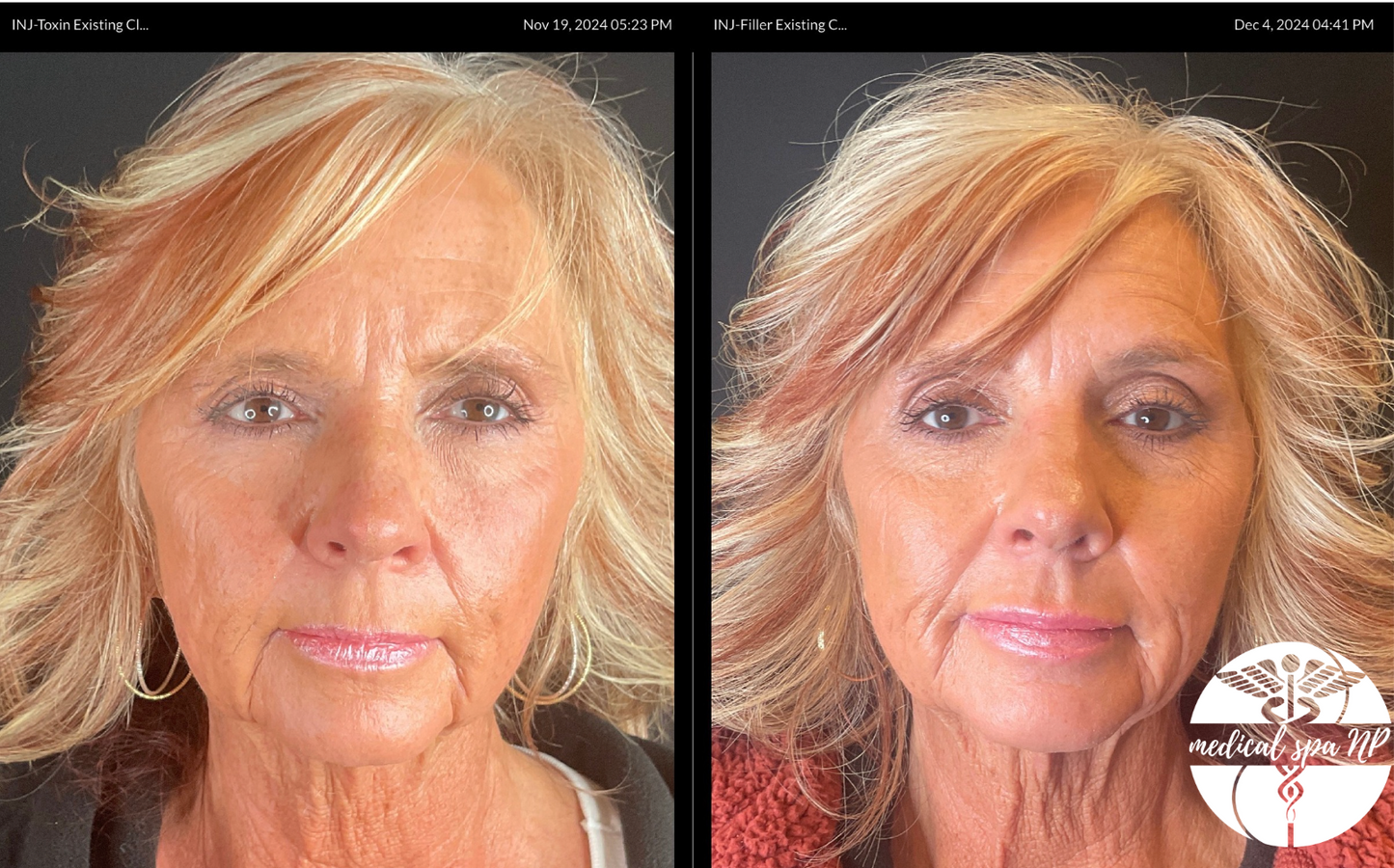 REVERSE AGING! Microneedling