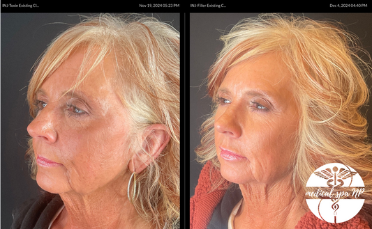 REVERSE AGING! Microneedling