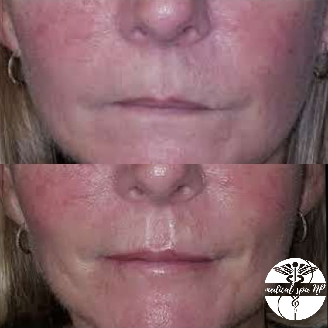 LIPS! Plump and Glow Lip Filler