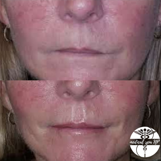LIPS! Plump and Glow Lip Filler